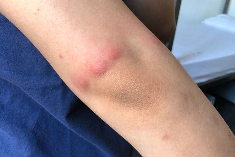 classic bedbug bite with three large red welt bites, nicknamed breakfast, lunch and dinner